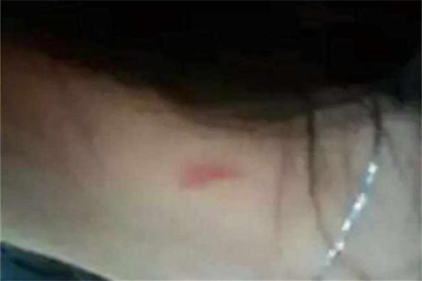 吻痕用雞蛋熱敷管用嗎 吻痕用雞蛋敷過后什么時候能消 吻痕用雞蛋熱敷管用嗎 吻痕用雞蛋敷過后什么時候能消