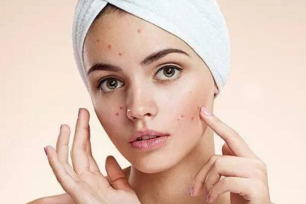 粉刺會(huì)留下痘印么 粉刺會(huì)長在哪些地方