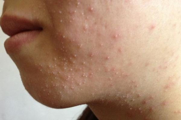 粉刺是什么原因長出來的 粉刺怎么可以有效的去除 粉刺是什么原因長出來的 粉刺怎么可以有效的去除