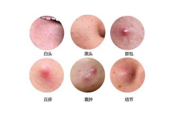粉刺是什么原因長出來的 粉刺怎么可以有效的去除 粉刺是什么原因長出來的 粉刺怎么可以有效的去除