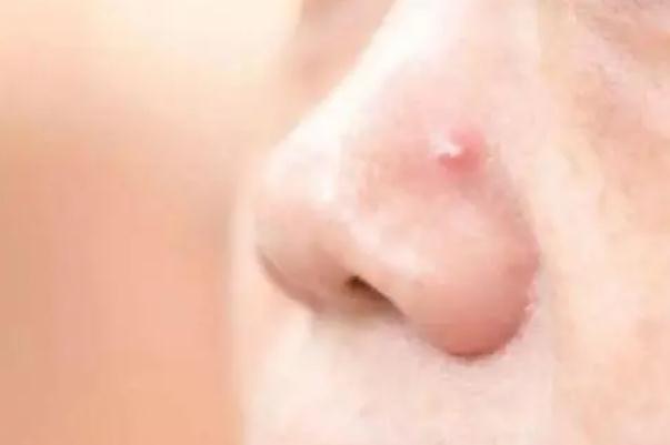 粉刺會留下痘印么 粉刺會長在哪些地方 粉刺會留下痘印么 粉刺會長在哪些地方