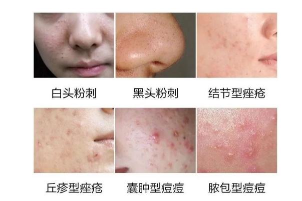 粉刺是什么原因長出來的 粉刺怎么可以有效的去除 粉刺是什么原因長出來的 粉刺怎么可以有效的去除