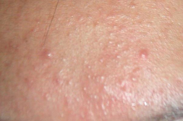 粉刺有硬塊但是擠不出來怎么辦 粉刺會傳染給別人嗎 粉刺有硬塊但是擠不出來怎么辦 粉刺會傳染給別人嗎