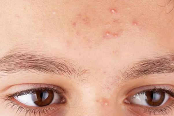 粉刺對(duì)身體有什么影響 擠黑頭粉刺會(huì)對(duì)皮膚有哪些影響 粉刺對(duì)身體有什么影響 擠黑頭粉刺會(huì)對(duì)皮膚有哪些影響