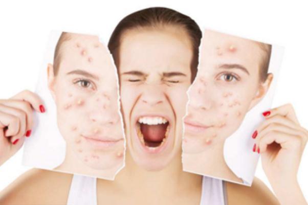 粉刺有膿包怎么處理 粉刺有白色的膿要不要擠掉 粉刺有膿包怎么處理 粉刺有白色的膿要不要擠掉