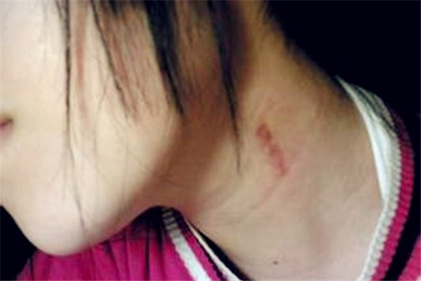 吻痕用雞蛋熱敷管用嗎 吻痕用雞蛋敷過后什么時候能消 吻痕用雞蛋熱敷管用嗎 吻痕用雞蛋敷過后什么時候能消