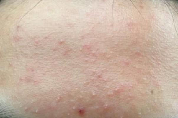 粉刺是痤瘡嗎 粉刺是螨蟲造成的嗎 粉刺是痤瘡嗎 粉刺是螨蟲造成的嗎