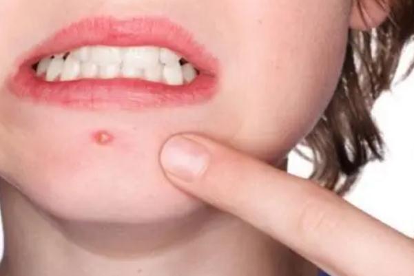 粉刺會留下痘印么 粉刺會長在哪些地方 粉刺會留下痘印么 粉刺會長在哪些地方