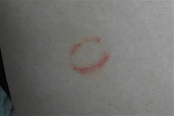 吻痕一般幾天能消除 吻痕怎么快速消除 吻痕一般幾天能消除 吻痕怎么快速消除
