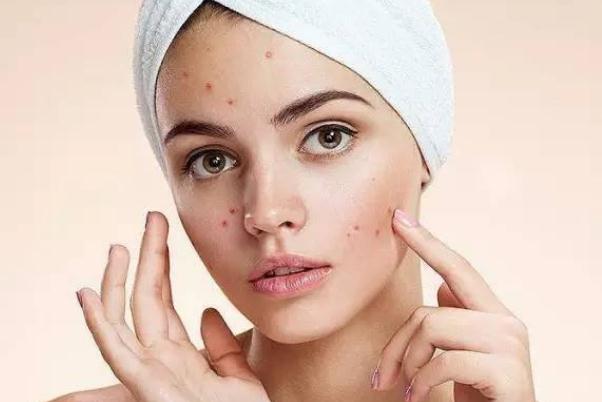 粉刺有硬塊但是擠不出來怎么辦 粉刺會傳染給別人嗎 粉刺有硬塊但是擠不出來怎么辦 粉刺會傳染給別人嗎