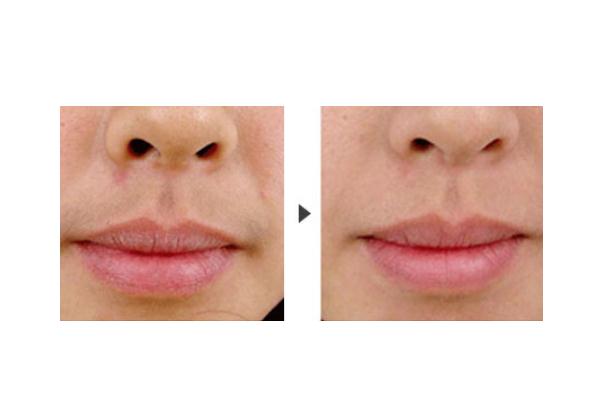 唇毛會自己慢慢消失嗎 唇毛會自己脫落嗎 唇毛會自己慢慢消失嗎 唇毛會自己脫落嗎