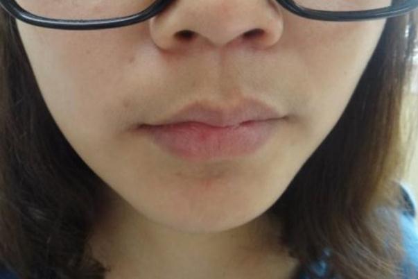 唇毛是脫毛好還是漂白好 唇毛是什么原因?qū)е碌? alt=