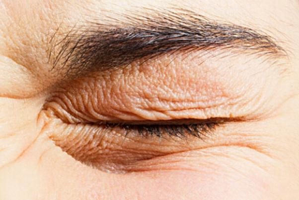 眼部細紋可以熱敷嗎 眼部細紋能淡化嗎 眼部細紋可以熱敷嗎 眼部細紋能淡化嗎