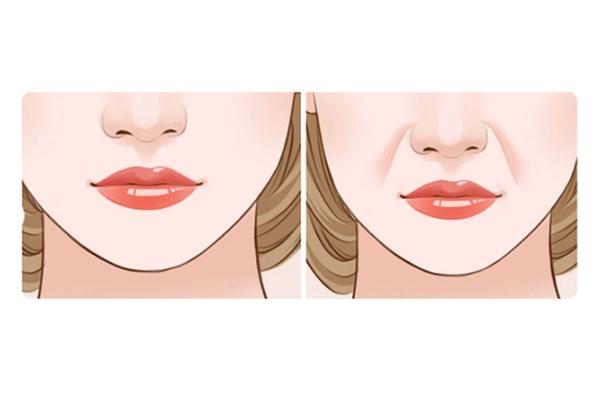 法令紋是怎么導(dǎo)致出來(lái)的 法令紋去除最好的方法 法令紋是怎么導(dǎo)致出來(lái)的 法令紋去除最好的方法