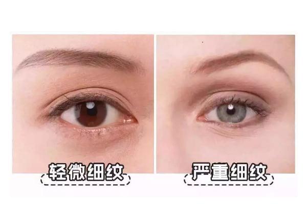 細紋是怎么產生的 細紋干紋怎么消除 細紋是怎么產生的 細紋干紋怎么消除