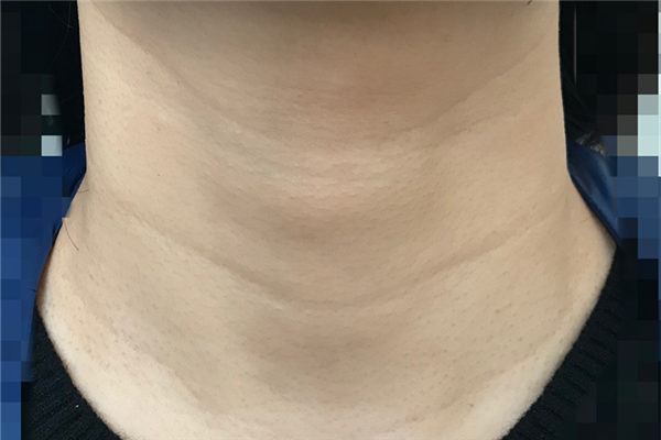 頸紋去除術可以維持多久 頸紋去除術是永久的嗎 頸紋去除術可以維持多久 頸紋去除術是永久的嗎