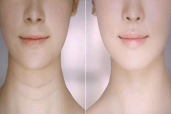 頸紋去除術(shù)一般多少錢 頸紋特別深怎么去除 頸紋去除術(shù)一般多少錢 頸紋特別深怎么去除