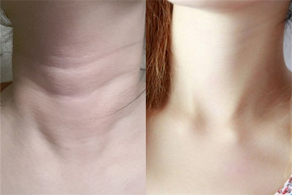 頸紋是怎么引起的 頸紋怎么消除簡(jiǎn)單的方法 頸紋是怎么引起的 頸紋怎么消除簡(jiǎn)單的方法