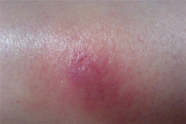 火癤子長屁股上怎么辦 火癤子哪里都長嗎 火癤子長屁股上怎么辦 火癤子哪里都長嗎