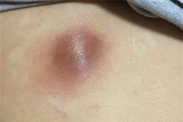 火癤子怎么治療最快 火癤子是什么引起的 火癤子怎么治療最快 火癤子是什么引起的