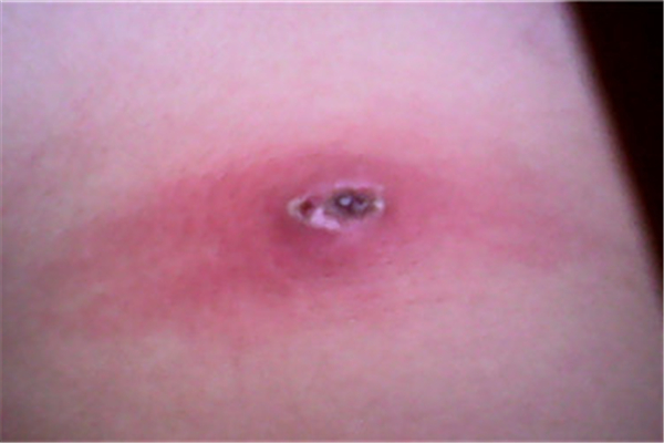 火癤子會(huì)自愈嗎 火癤子長(zhǎng)什么樣 火癤子會(huì)自愈嗎 火癤子長(zhǎng)什么樣