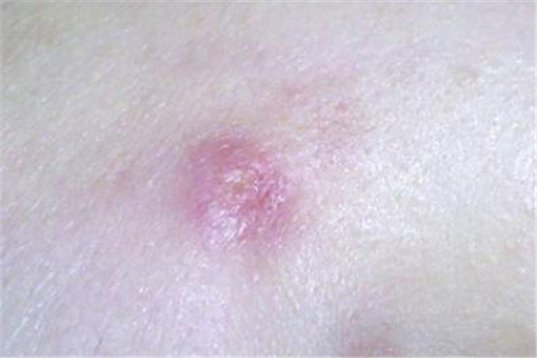 火癤子有了白點可以擠破嗎 火癤子可以刺破嗎 火癤子有了白點可以擠破嗎 火癤子可以刺破嗎