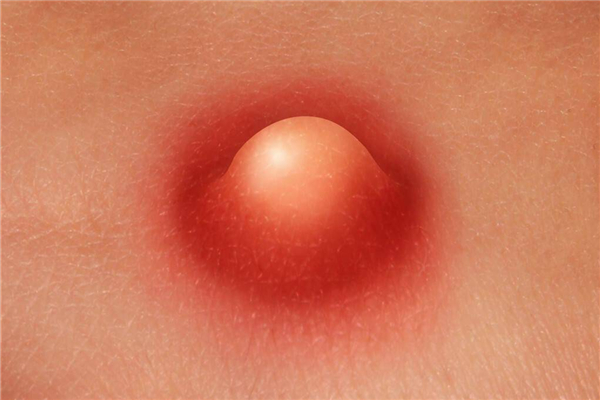 火癤子有了白點可以擠破嗎 火癤子可以刺破嗎 火癤子有了白點可以擠破嗎 火癤子可以刺破嗎