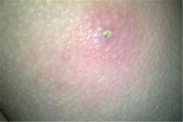 火癤子長屁股上怎么辦 火癤子哪里都長嗎 火癤子長屁股上怎么辦 火癤子哪里都長嗎