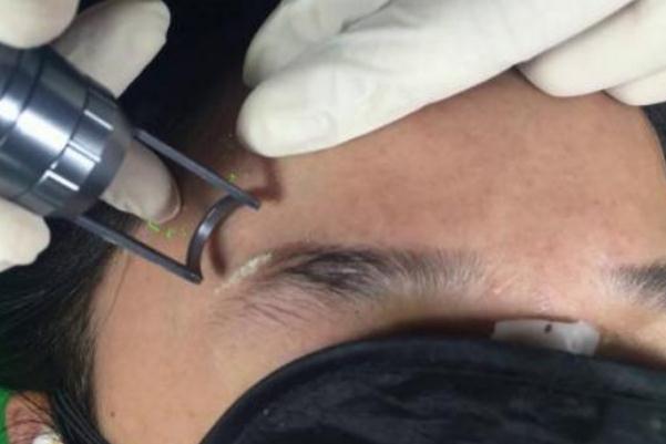 激光洗眉會(huì)留下疤痕嗎 激光洗眉一般需要多少錢 激光洗眉會(huì)留下疤痕嗎 激光洗眉一般需要多少錢