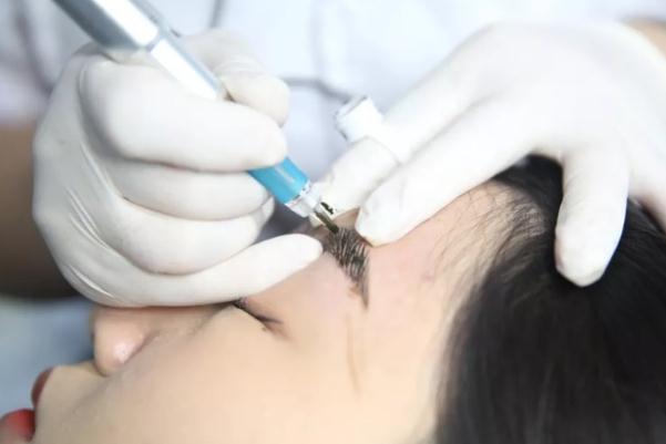 激光洗眉能徹底洗干凈嗎 激光洗眉的紅印多久可以消退 激光洗眉能徹底洗干凈嗎 激光洗眉的紅印多久可以消退