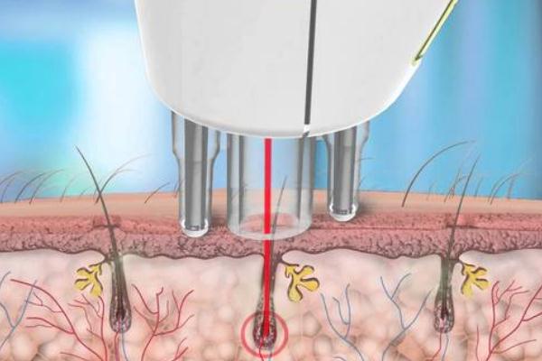 激光脫毛和冰點(diǎn)脫毛有什么區(qū)別 激光脫毛有什么后遺癥 激光脫毛和冰點(diǎn)脫毛有什么區(qū)別 激光脫毛有什么后遺癥