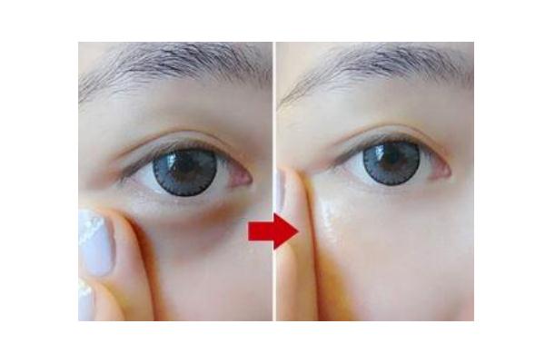 黑眼圈能自己消除嗎 黑眼圈手術(shù)一般多少錢 黑眼圈能自己消除嗎 黑眼圈手術(shù)一般多少錢