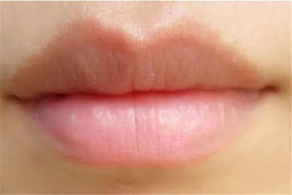 豐唇可以吃消炎藥嗎 豐唇吃什么食物 豐唇可以吃消炎藥嗎 豐唇吃什么食物