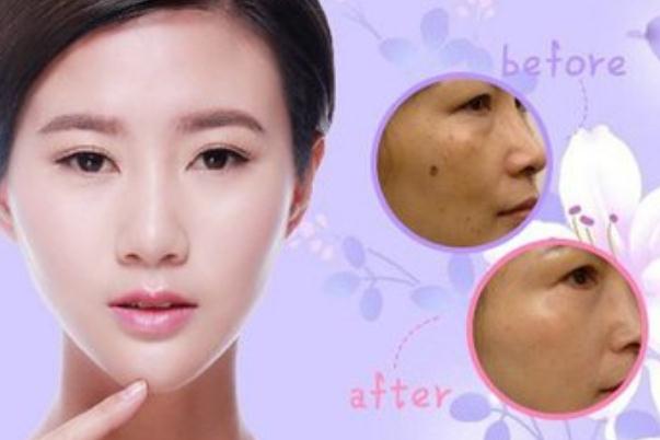 點痣去醫(yī)院掛什么科 點痣后需要注意什么事項 點痣去醫(yī)院掛什么科 點痣后需要注意什么事項