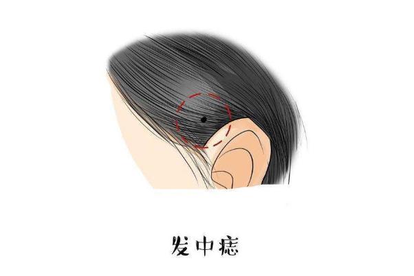 點痣要幾次才干凈 點痣要打麻藥嗎 點痣要幾次才干凈 點痣要打麻藥嗎