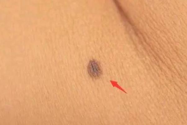 點(diǎn)痣要幾次才干凈 點(diǎn)痣要打麻藥嗎 點(diǎn)痣要幾次才干凈 點(diǎn)痣要打麻藥嗎