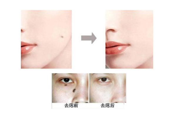 點(diǎn)痣的痂幾天脫落 點(diǎn)痣的印子多久能消除 點(diǎn)痣的痂幾天脫落 點(diǎn)痣的印子多久能消除