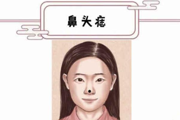 點痣有什么副作用 點痣有幾種方法 點痣有什么副作用 點痣有幾種方法