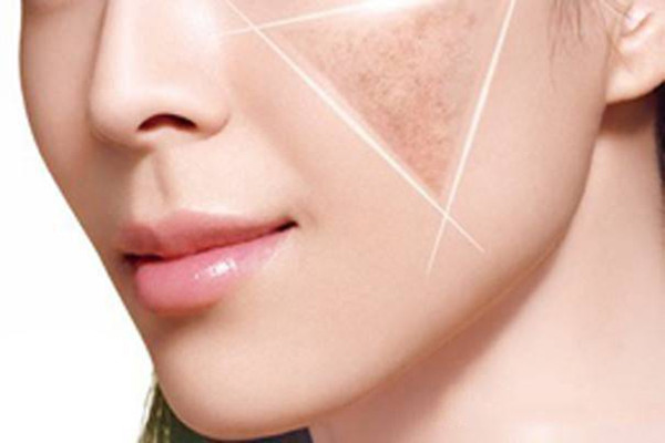 曬斑是什么 曬斑是如何形成的 曬斑是什么 曬斑是如何形成的