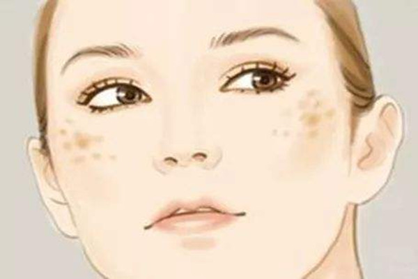 曬斑是什么樣子的 曬斑是因為防曬沒做好嗎 曬斑是什么樣子的 曬斑是因為防曬沒做好嗎