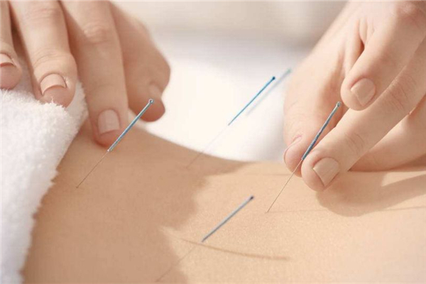 針灸對腰間盤突出有用嗎 針灸是什么原理治病 針灸對腰間盤突出有用嗎 針灸是什么原理治病