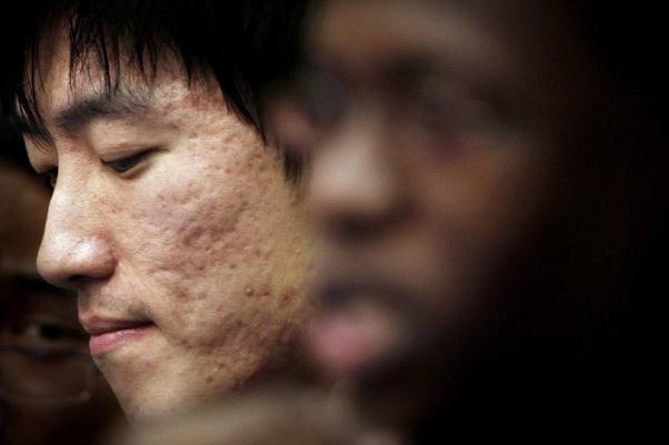 青春痘留下的疤痕怎么才能消除掉 青春痘和痤瘡有什么區(qū)別 青春痘留下的疤痕怎么才能消除掉 青春痘和痤瘡有什么區(qū)別