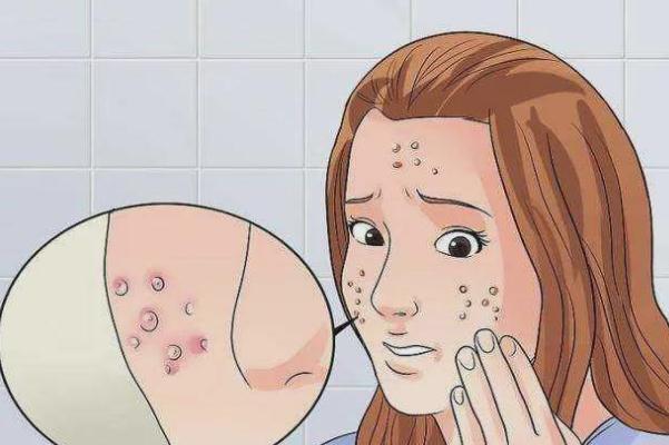 青春痘會(huì)長(zhǎng)在哪些部位 青春痘會(huì)長(zhǎng)在背上嗎 青春痘會(huì)長(zhǎng)在哪些部位 青春痘會(huì)長(zhǎng)在背上嗎