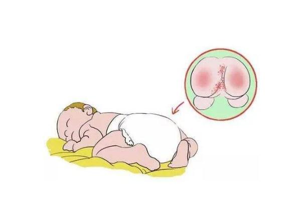 尿布疹要多久能好 尿布疹要換尿不濕品牌嗎 尿布疹要多久能好 尿布疹要換尿不濕品牌嗎