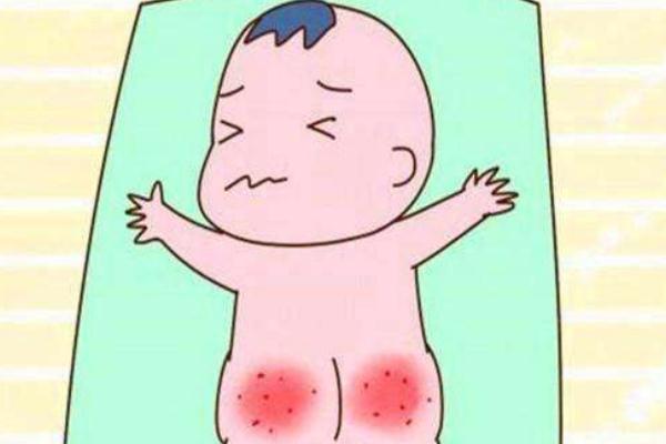 尿布疹擦什么藥好得快 尿布疹怎么護(hù)理才能好 尿布疹擦什么藥好得快 尿布疹怎么護(hù)理才能好