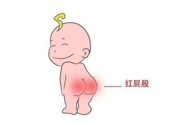 尿布疹的癥狀有哪些 尿布疹的預防要點是什么 尿布疹的癥狀有哪些 尿布疹的預防要點是什么