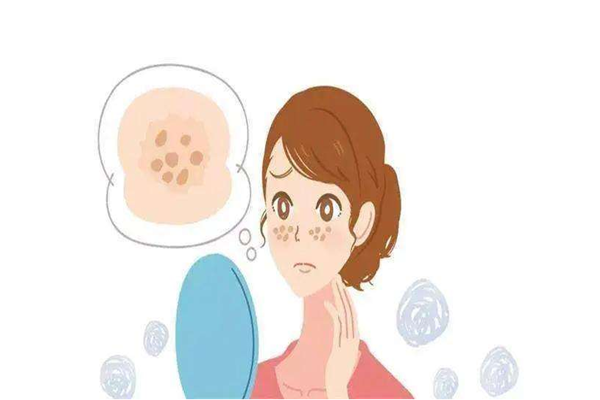 黃褐斑是怎么樣形成的 黃褐斑是什么樣子 黃褐斑是怎么樣形成的 黃褐斑是什么樣子