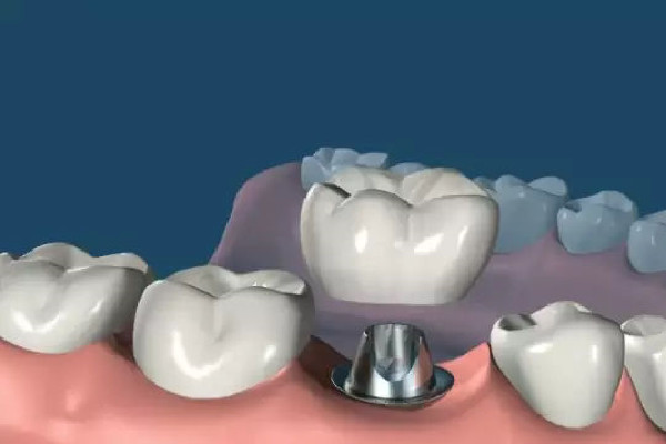 種牙后多長(zhǎng)時(shí)間能吃飯 種牙后飲食應(yīng)該注意什么 種牙后多長(zhǎng)時(shí)間能吃飯 種牙后飲食應(yīng)該注意什么