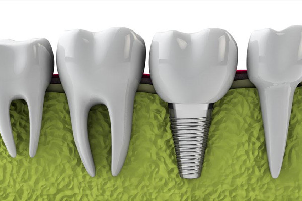 種牙后多長(zhǎng)時(shí)間能吃飯 種牙后飲食應(yīng)該注意什么 種牙后多長(zhǎng)時(shí)間能吃飯 種牙后飲食應(yīng)該注意什么