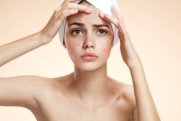 粉刺是不是越擠越多 粉刺是不是黑頭 粉刺是不是越擠越多 粉刺是不是黑頭